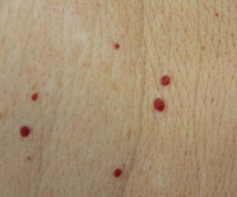 Blood Spots (Campbell De Morgan/Cherry Angiomas) | Sunshine For The Soul